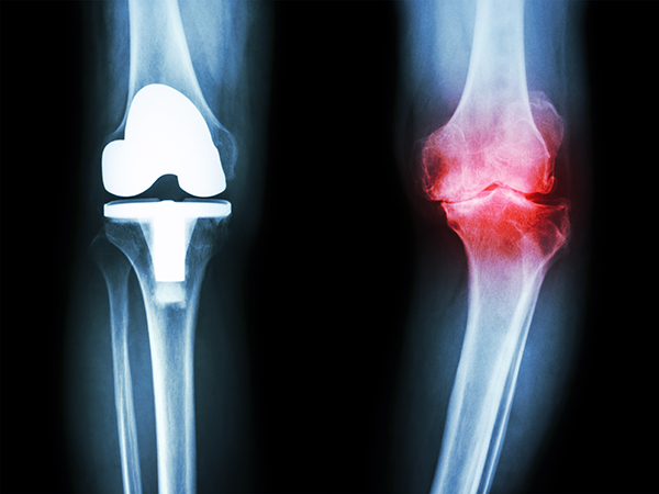 The Degenerative Conditions Treatment
